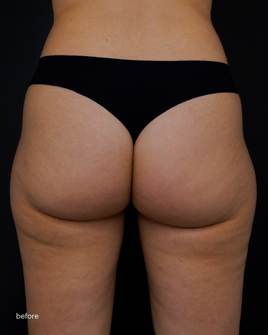 Mesoestetic  skinretin body cream