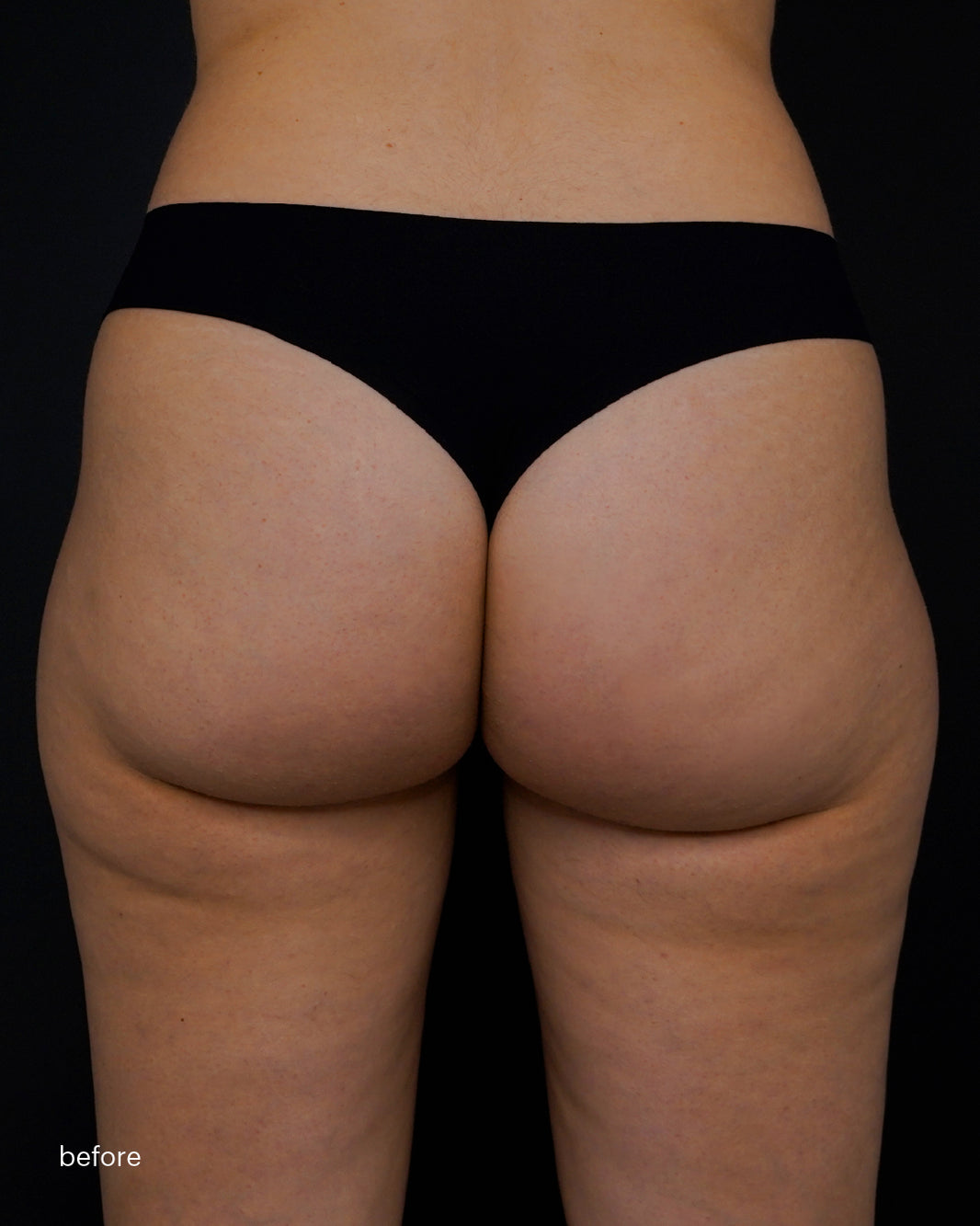 Mesoestetic  skinretin body cream