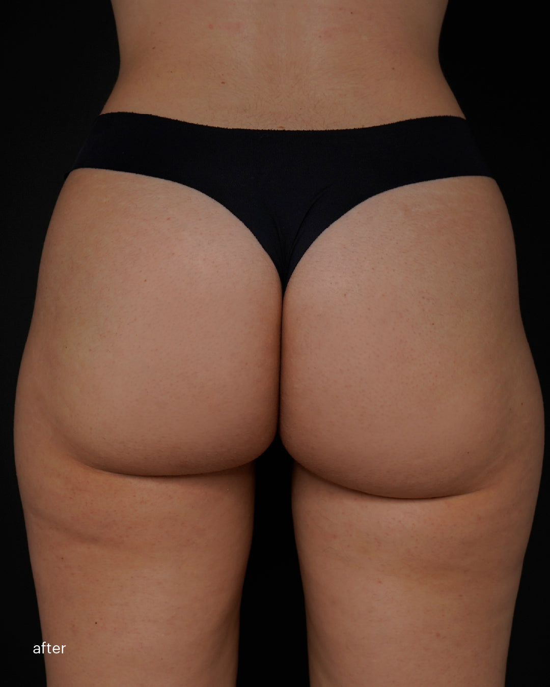 Mesoestetic  skinretin body cream