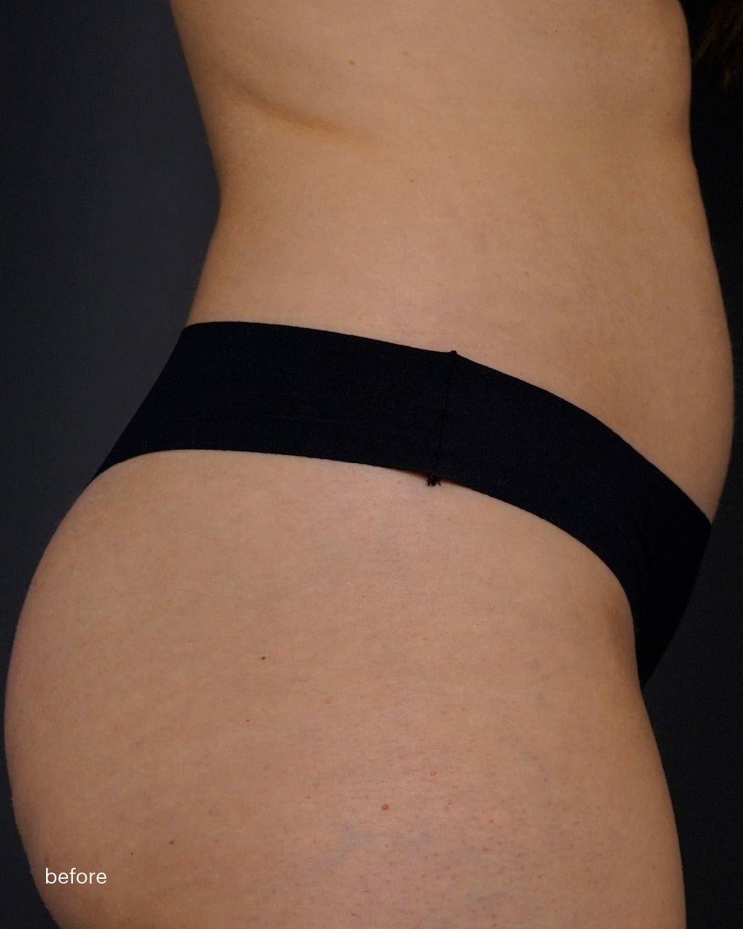 Mesoestetic  skinretin body cream